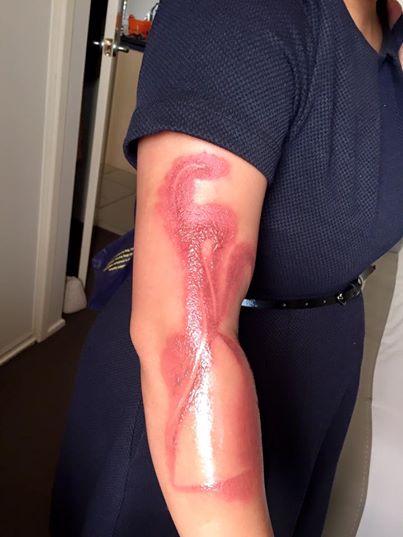 melanie-tan-pelaez-suffers-a-second-degree-burn-on-her-right-arm-after-falling-asleep-on-her-iphone-7